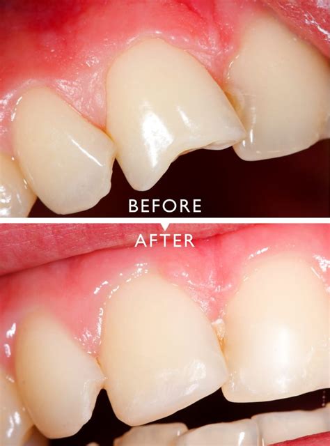 Ozark Chipped Tooth Repair 